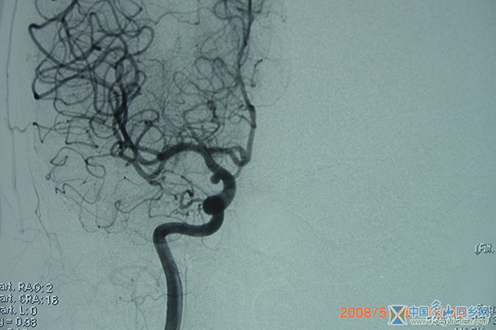 动脉瘤血管造影_(3).JPG